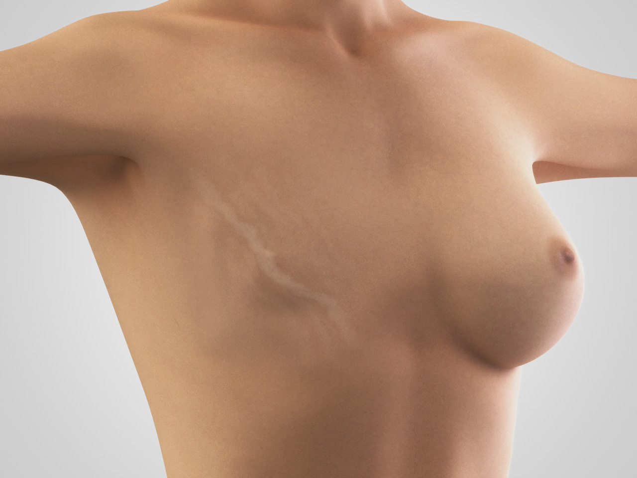 breast reconstruction 1